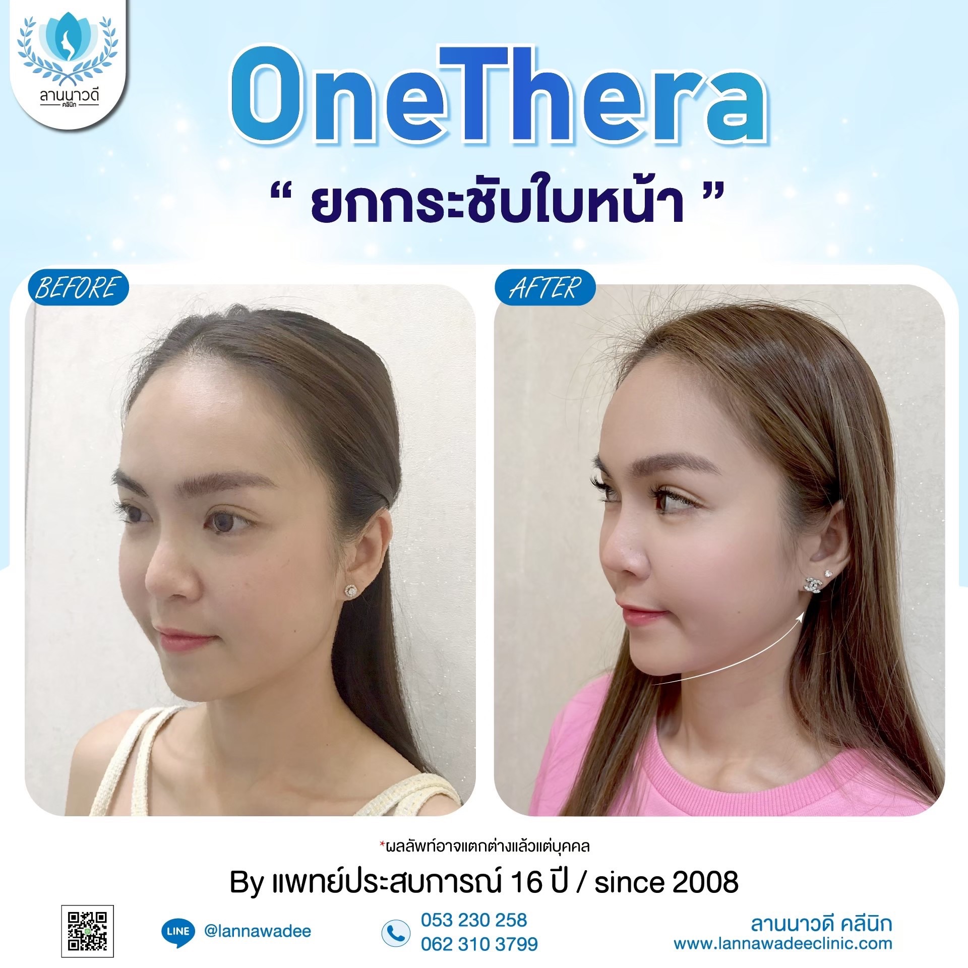 ยกกระชับ