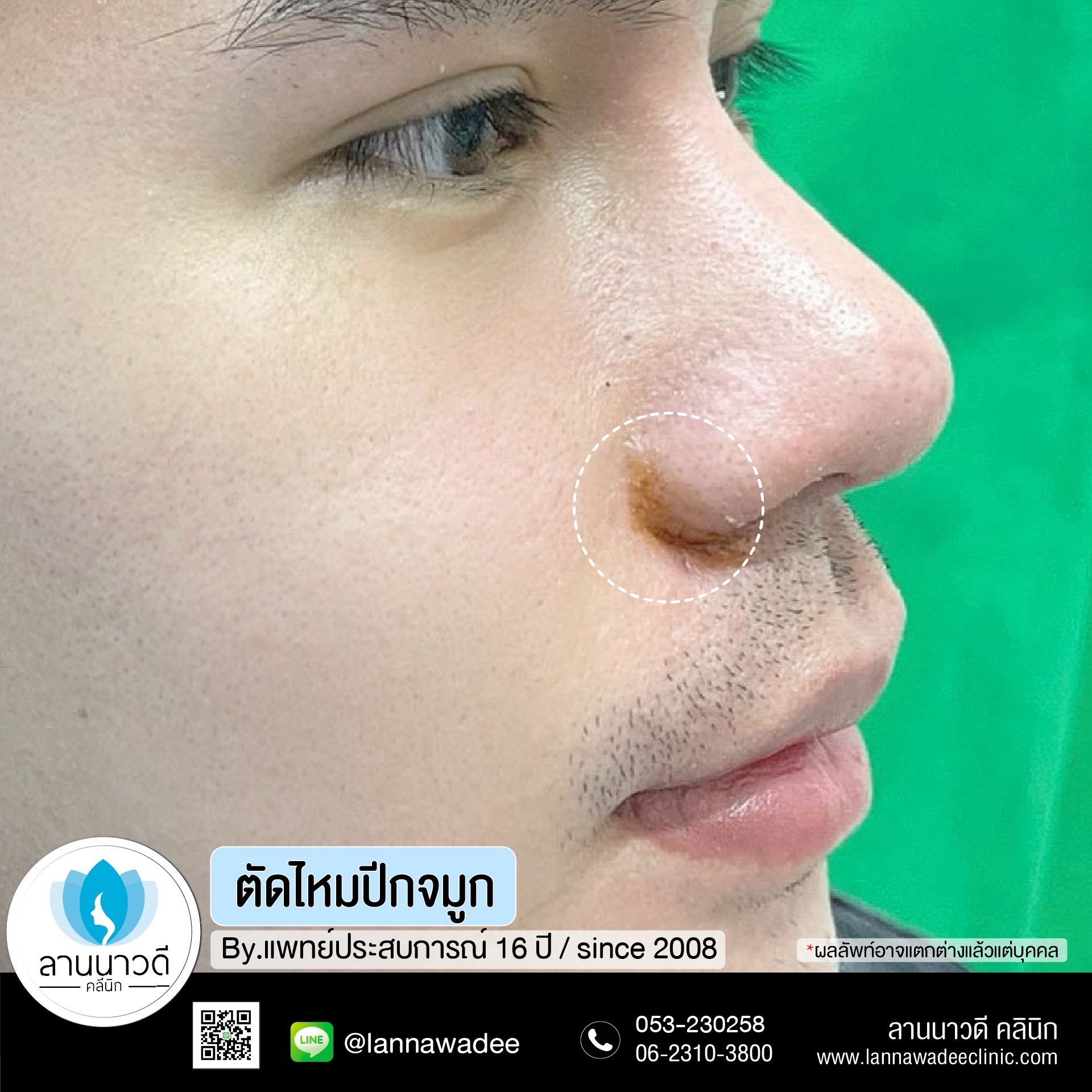 ตัดปีกจมูก