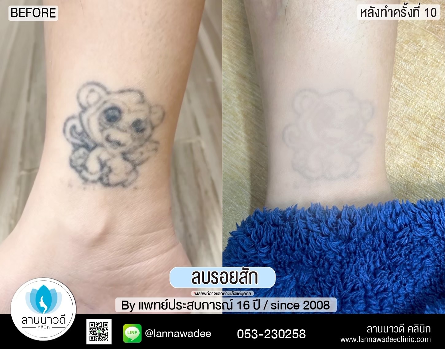 ลบรอยสัก