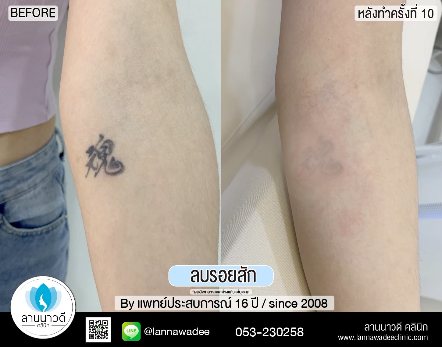 เลเซอร์