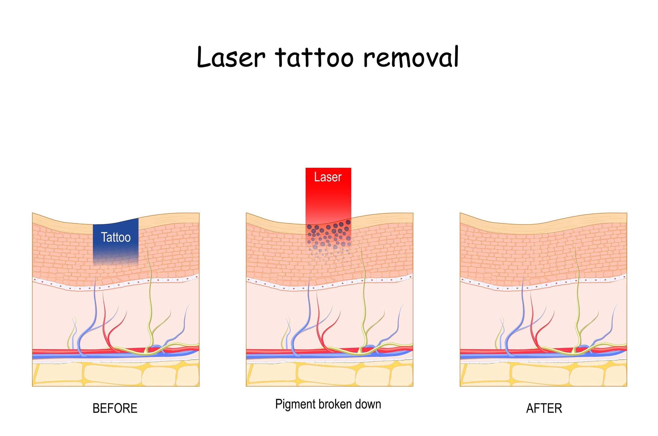 ลบรอยสัก
