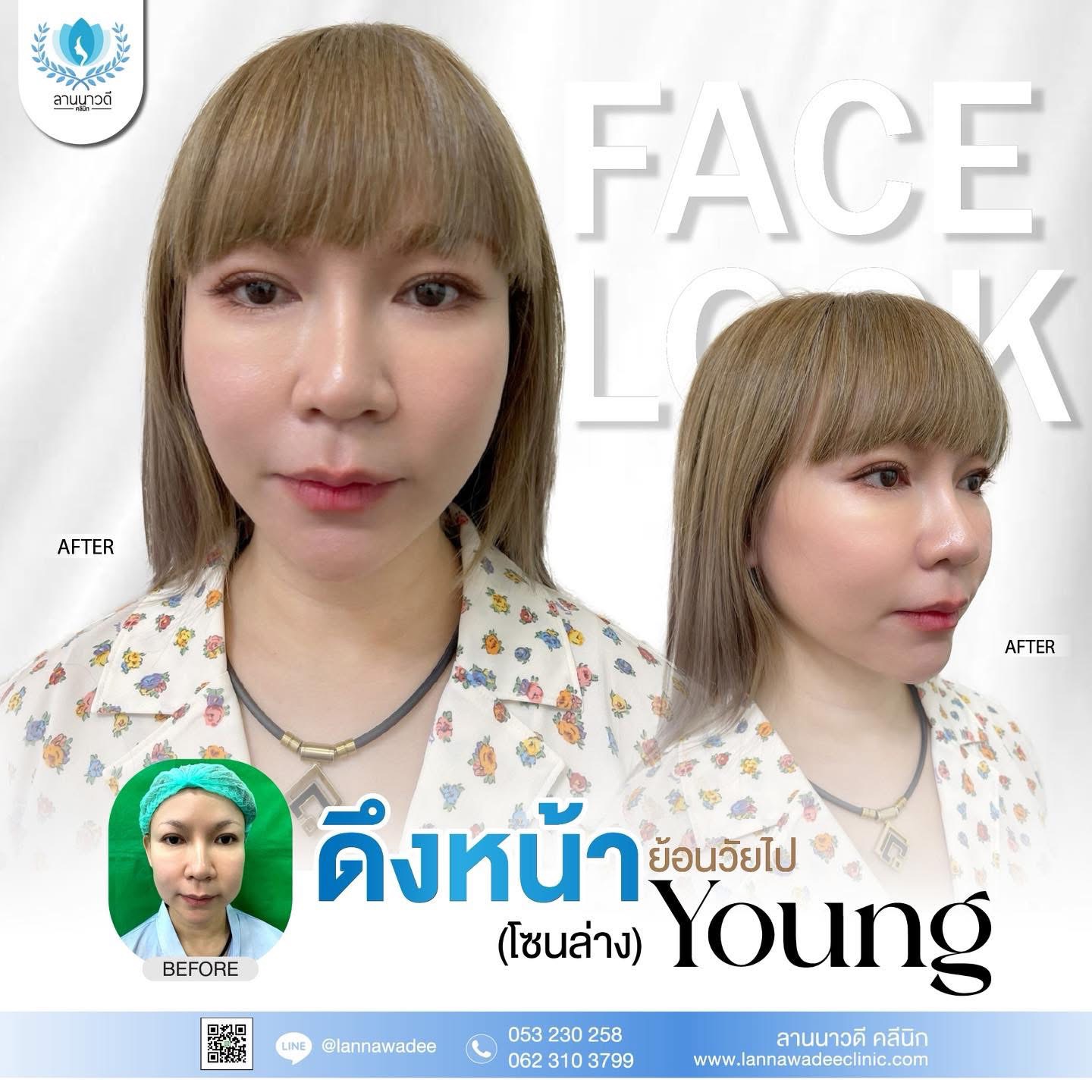 ดึงหน้า