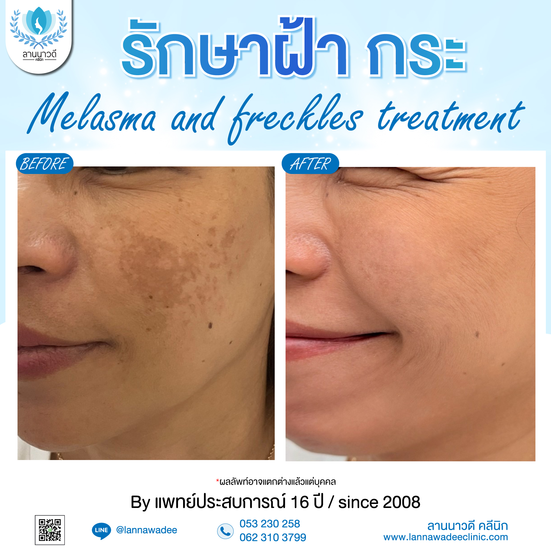 คลินิกรักษาฝ้ากระ