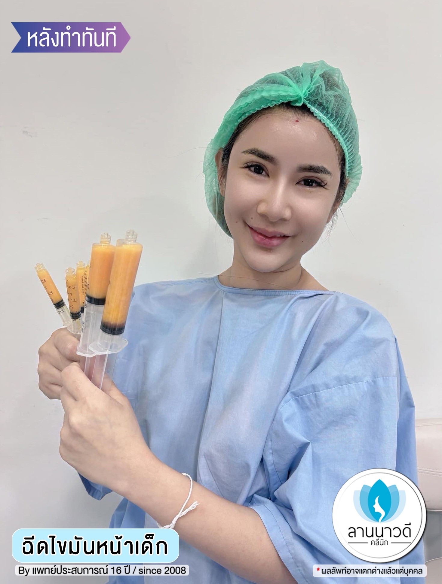 ฉีด fat หน้า เชียงใหม่