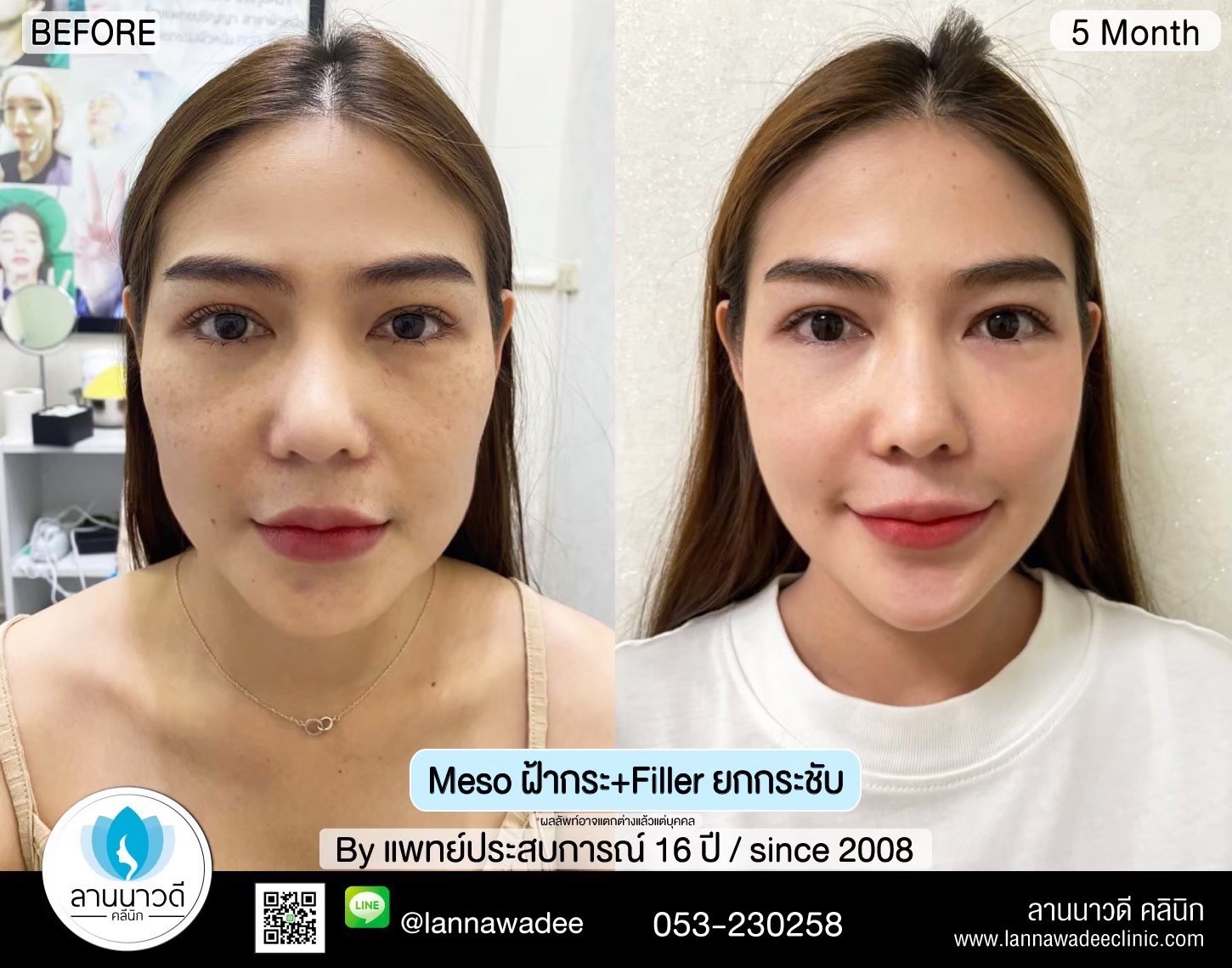 เลเซอร์ฝ้ากระที่ไหนดี