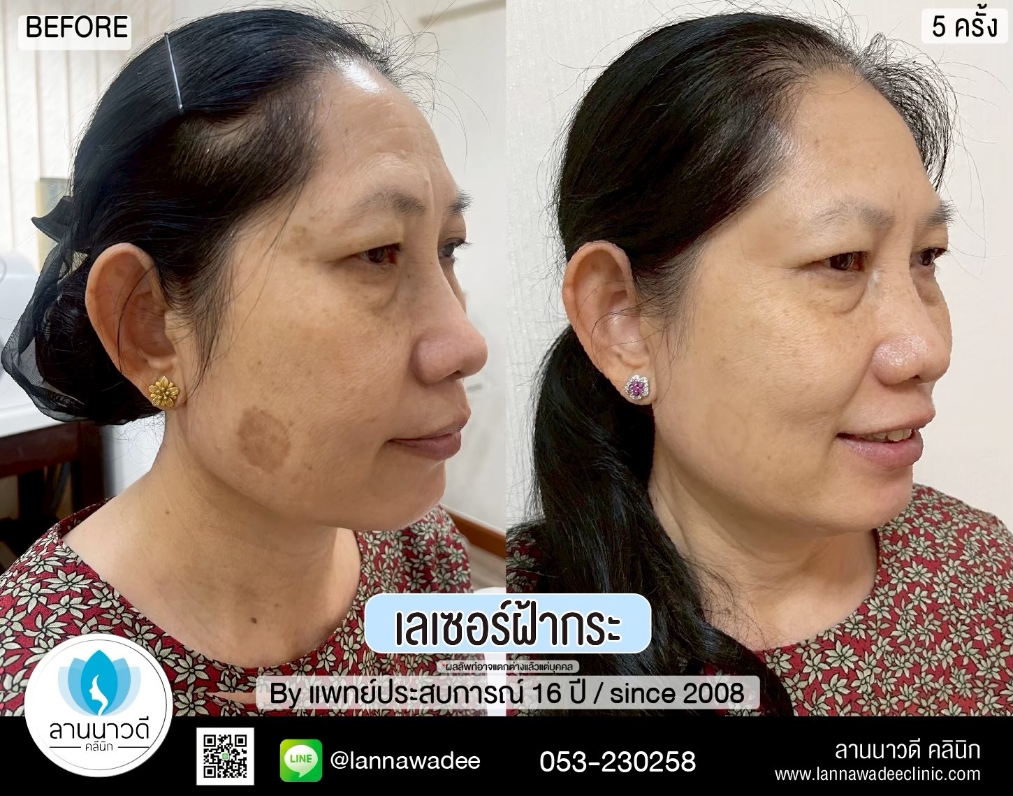 เลเซอร์ฝ้ากระที่ไหนดี