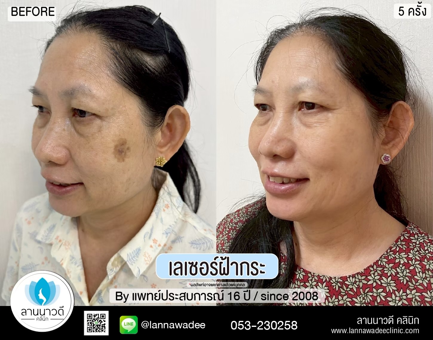 เลเซอร์ฝ้ากระที่ไหนดี