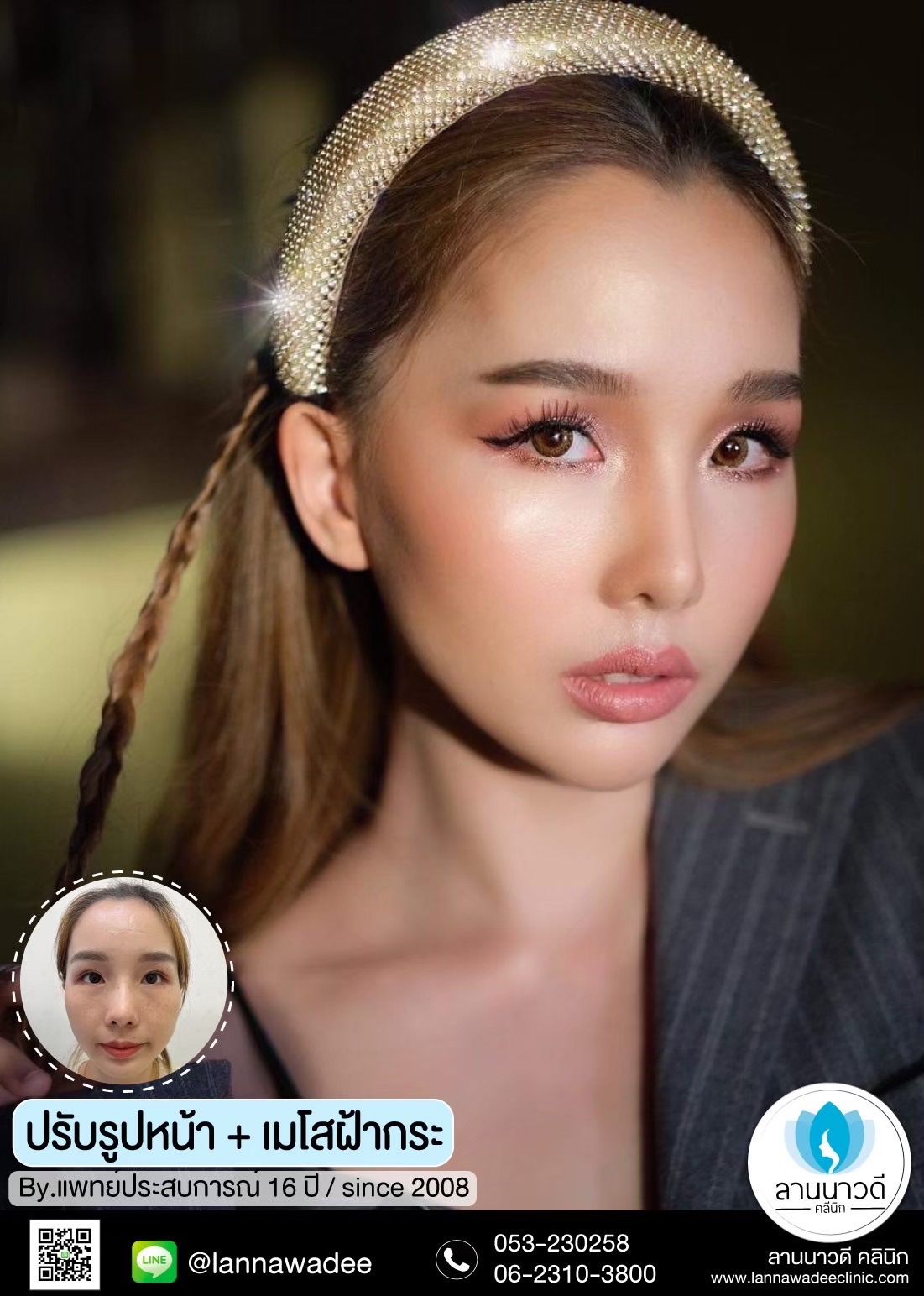 เลเซอร์ฝ้ากระที่ไหนดี