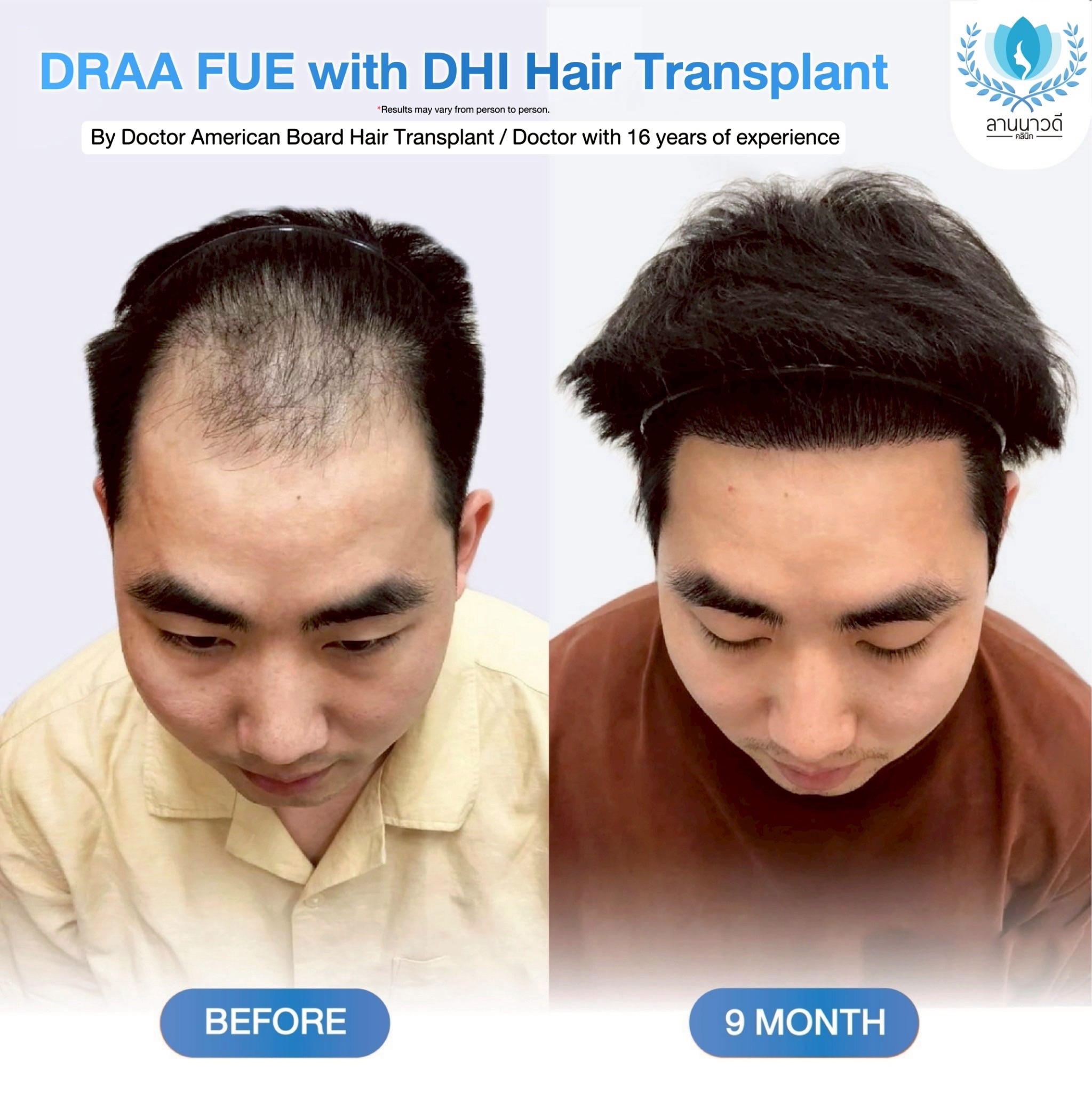 ABHRS hair transplant Thailand