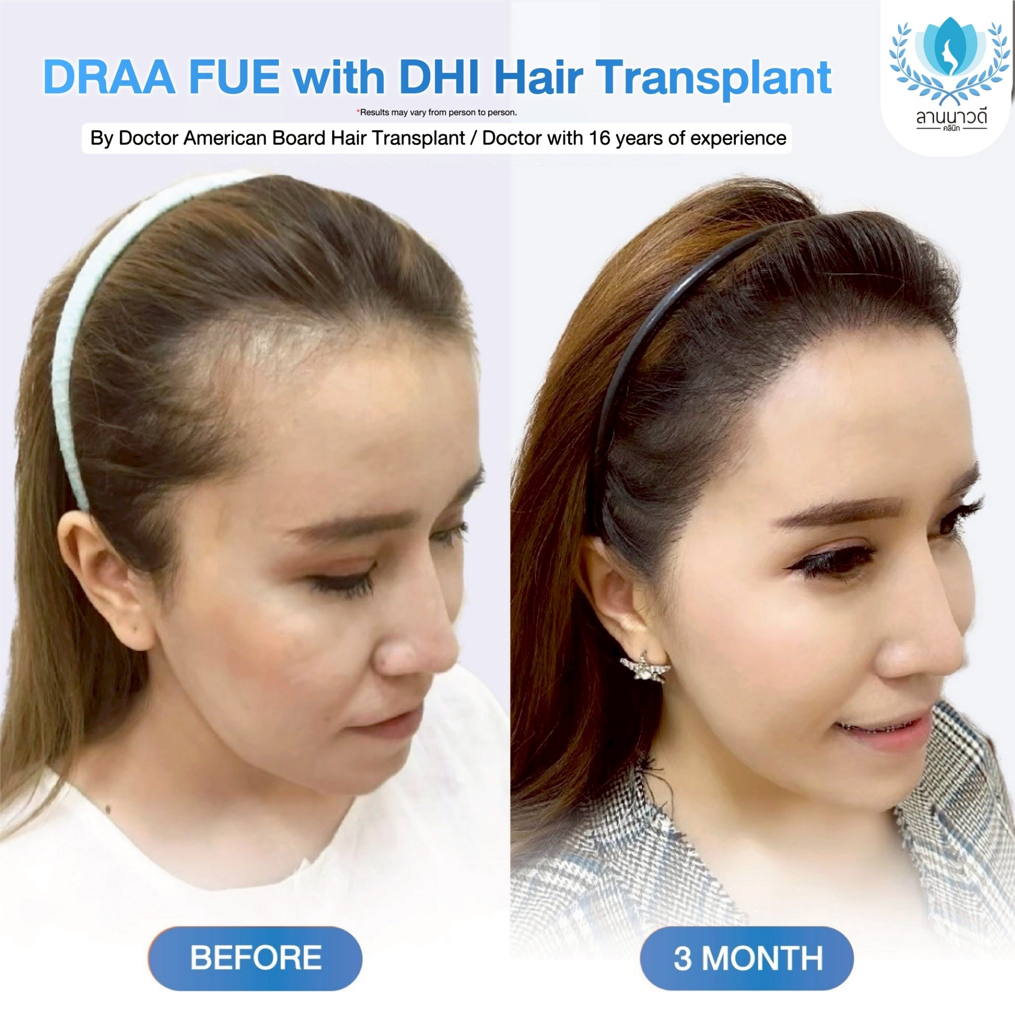 ABHRS hair transplant Thailand