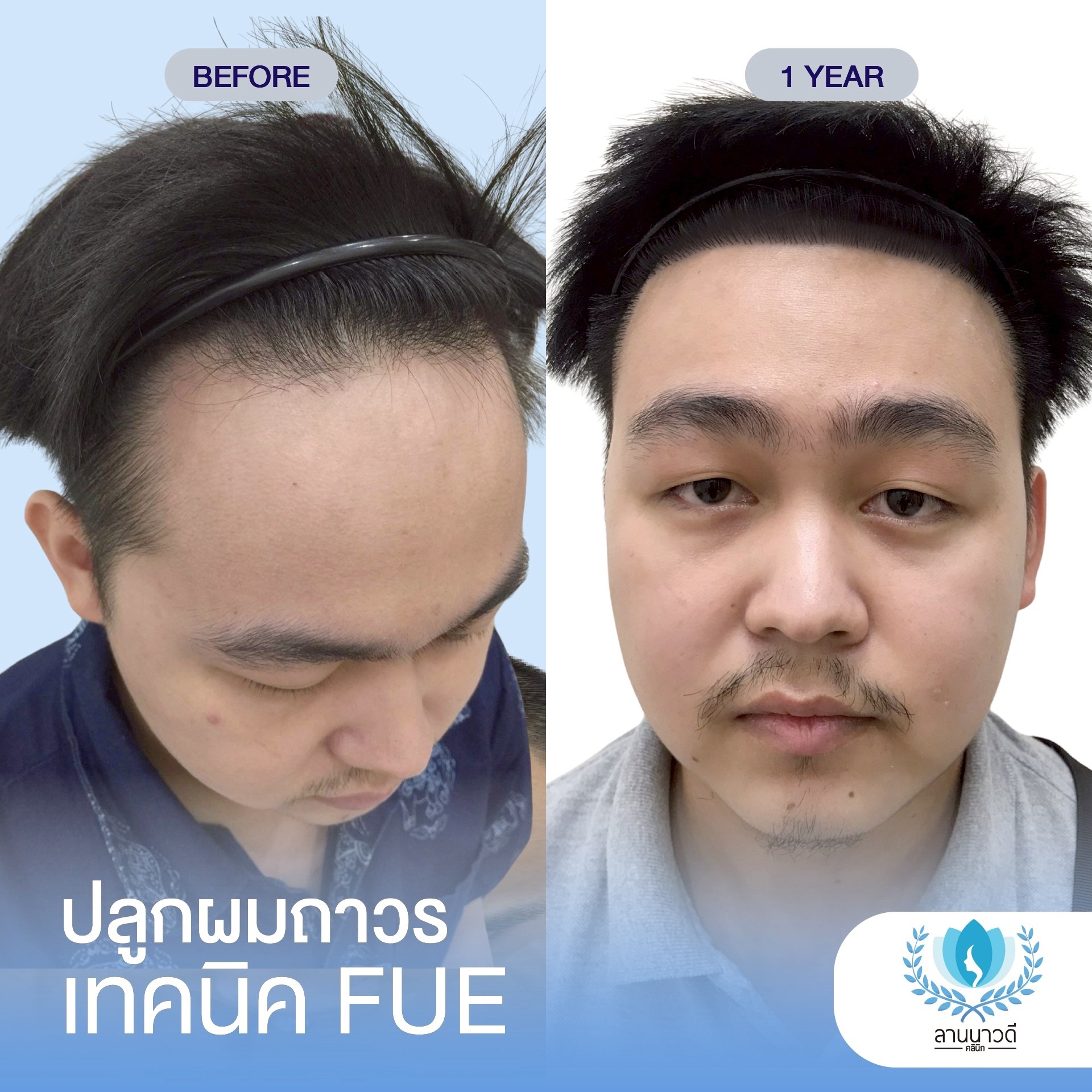 ABHRS hair transplant Thailand
