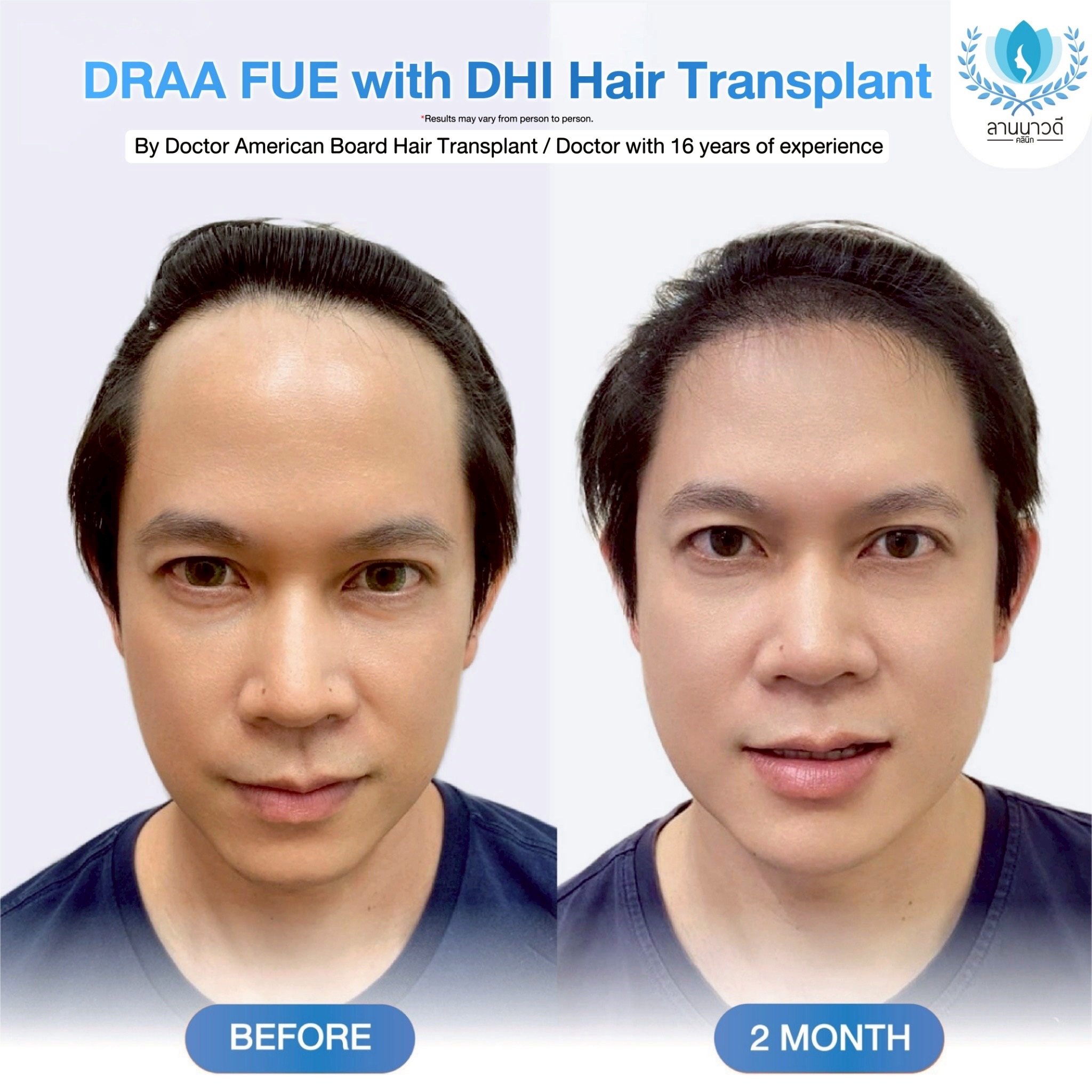 ABHRS hair transplant Thailand