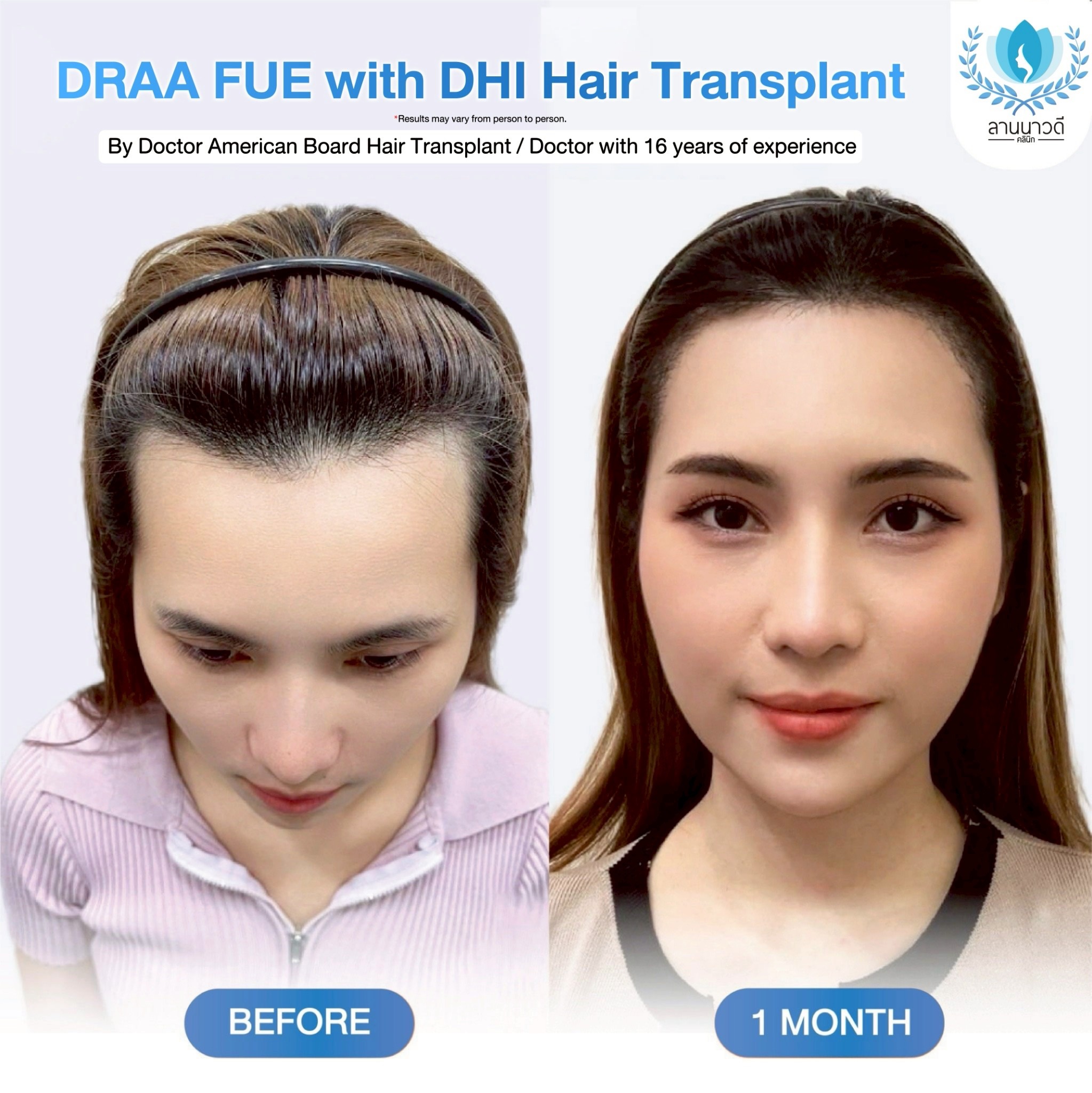 ABHRS hair transplant Thailand