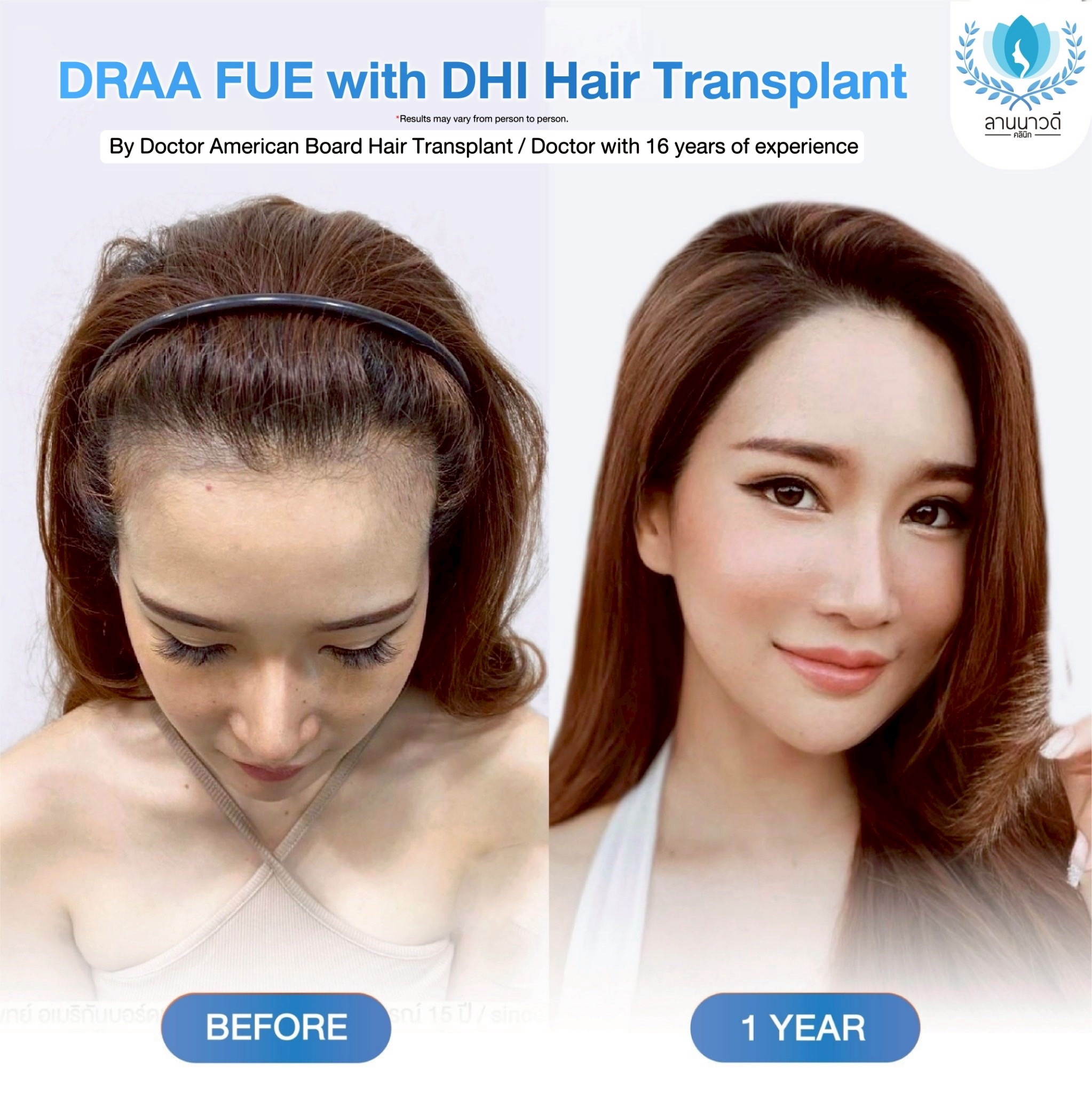 ABHRS hair transplant Thailand
