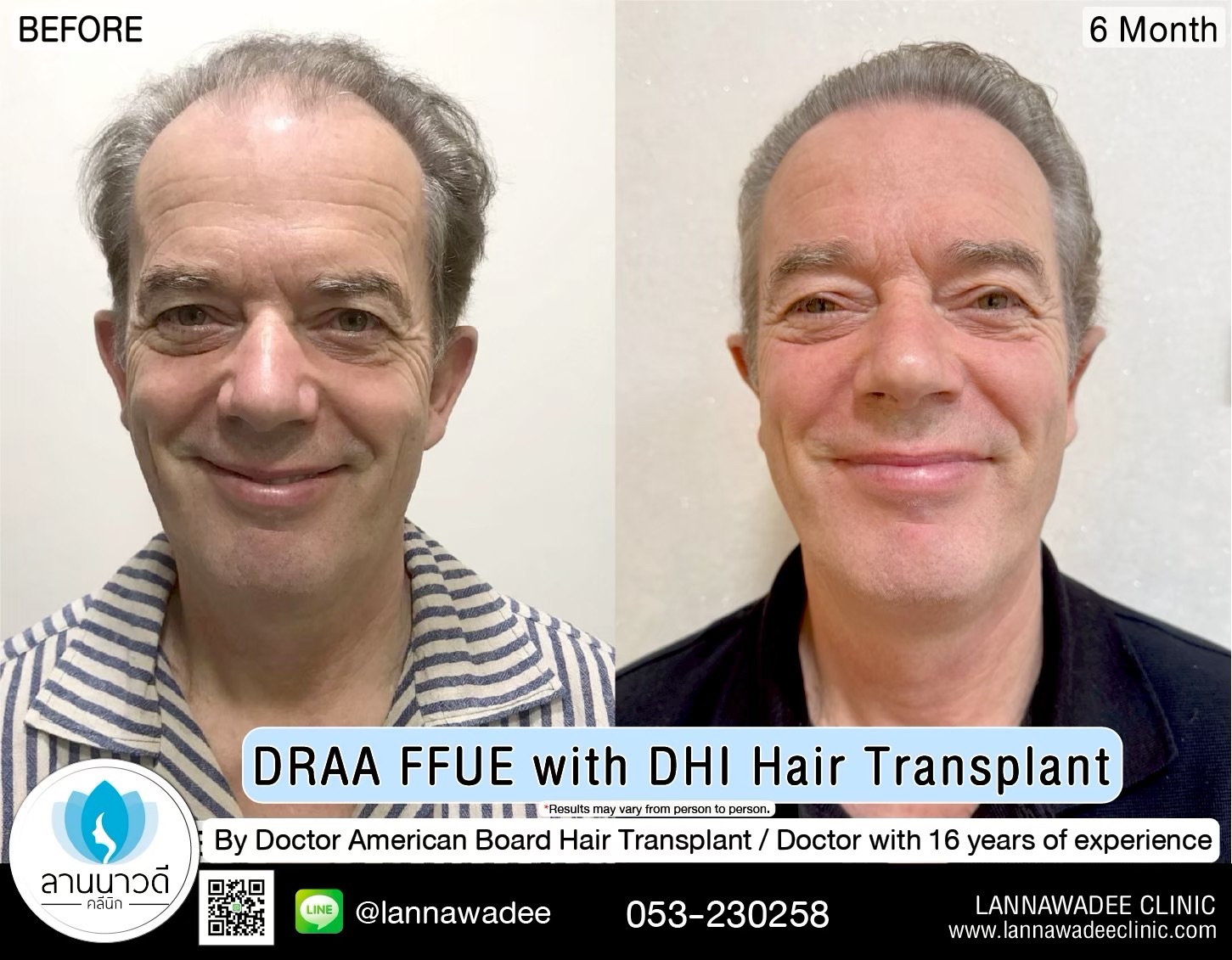 ABHRS hair transplant Thailand