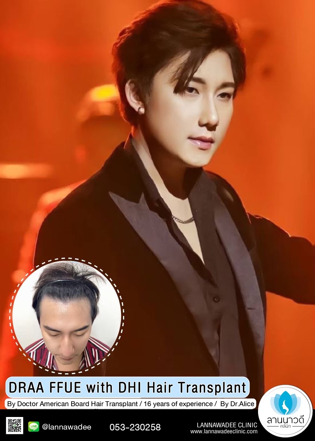 ABHRS hair transplant Thailand