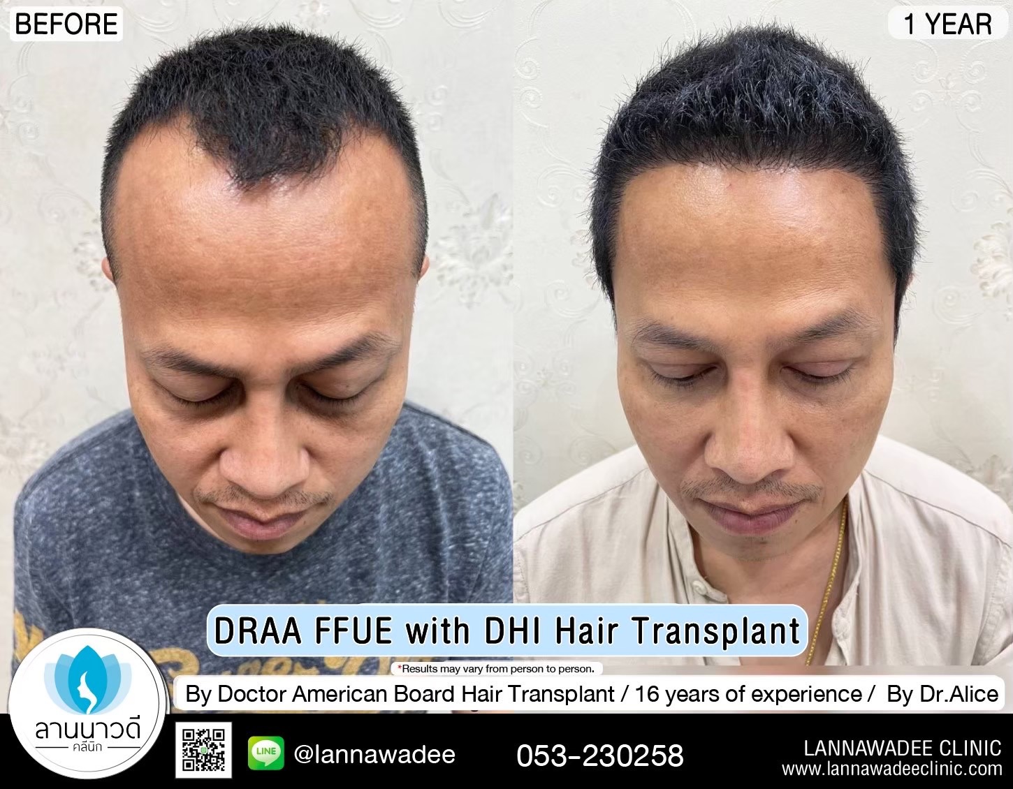ABHRS hair transplant Thailand