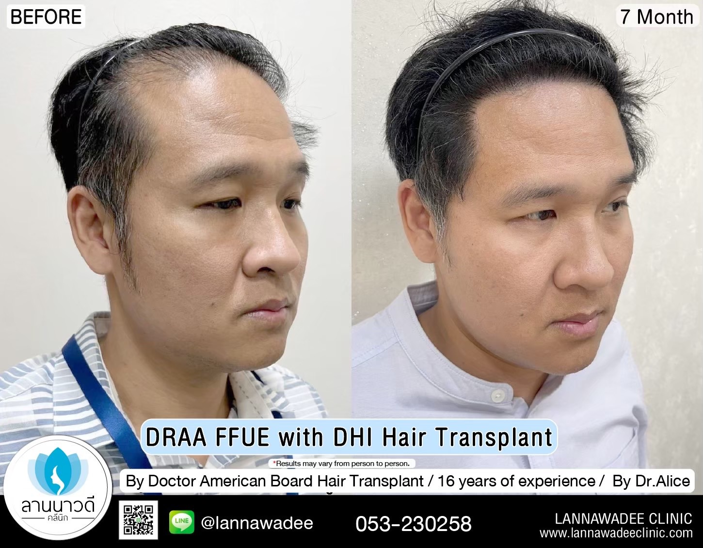ABHRS hair transplant Thailand