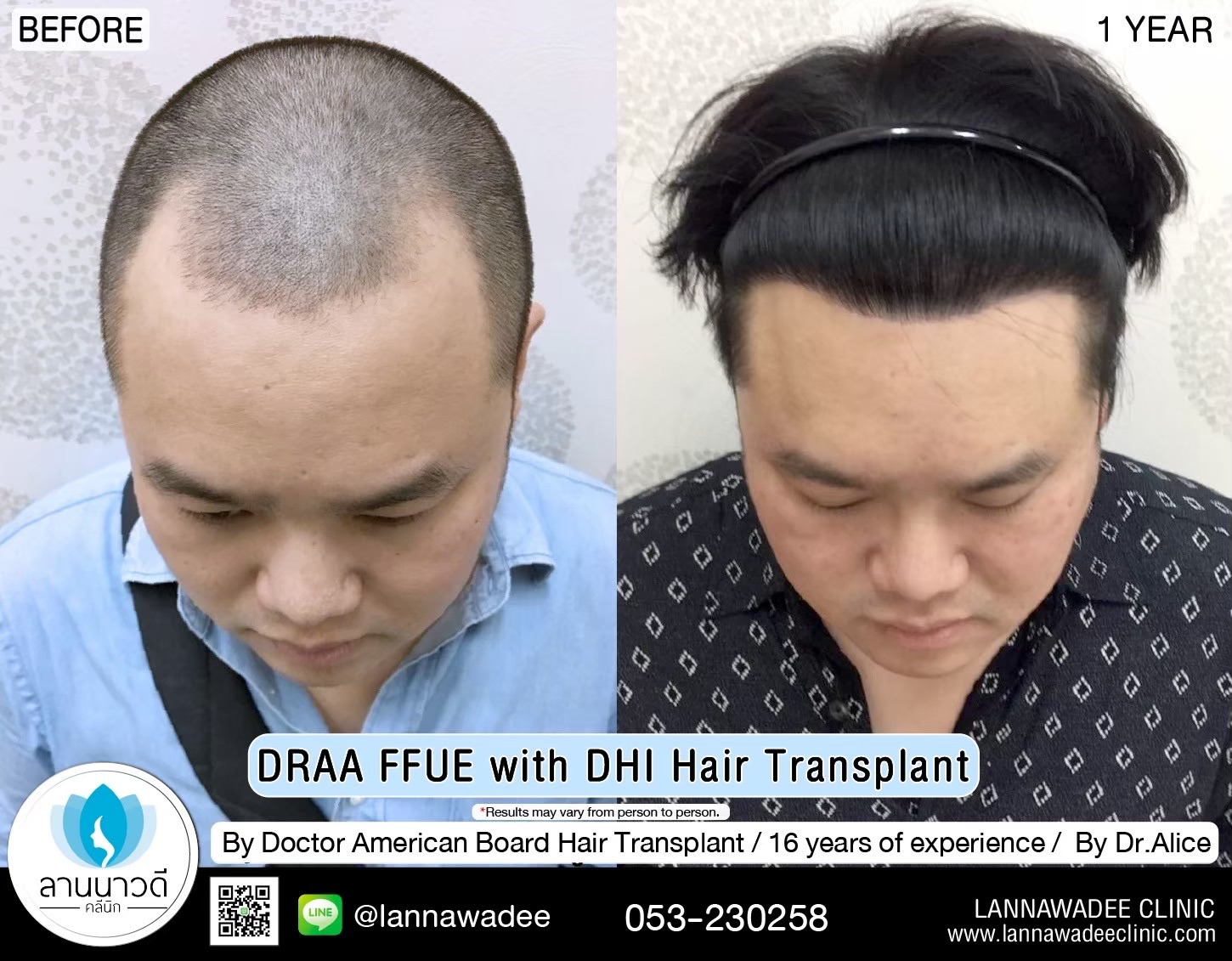 ABHRS hair transplant Thailand