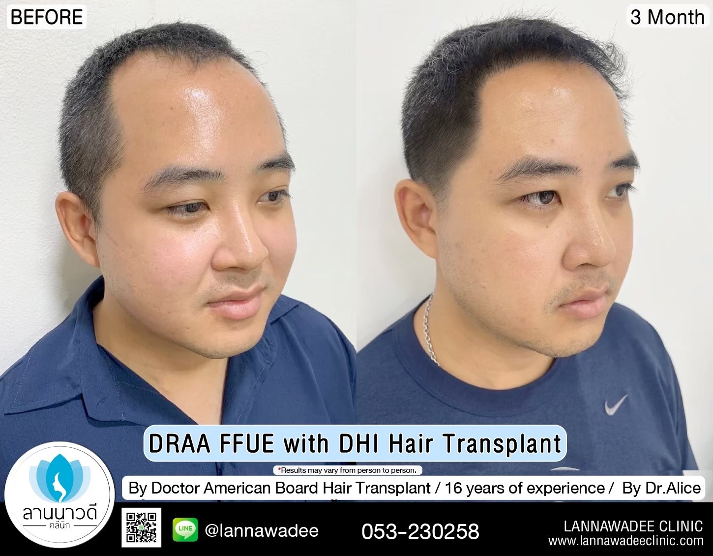 ABHRS hair transplant Thailand