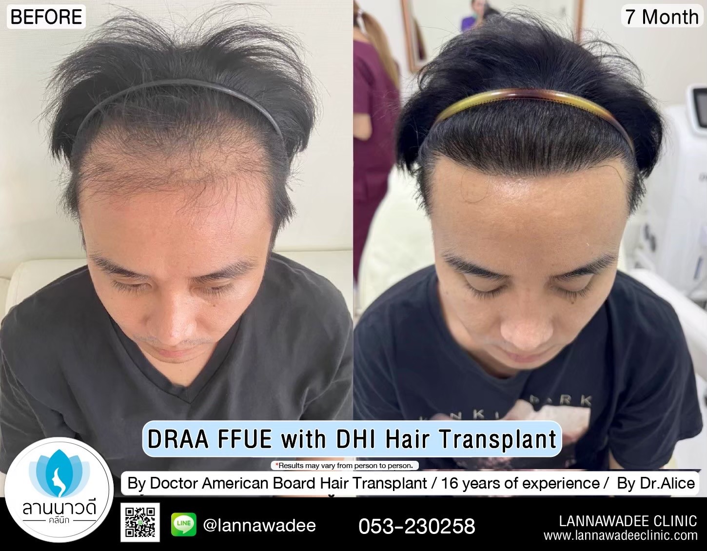 ABHRS hair transplant Thailand