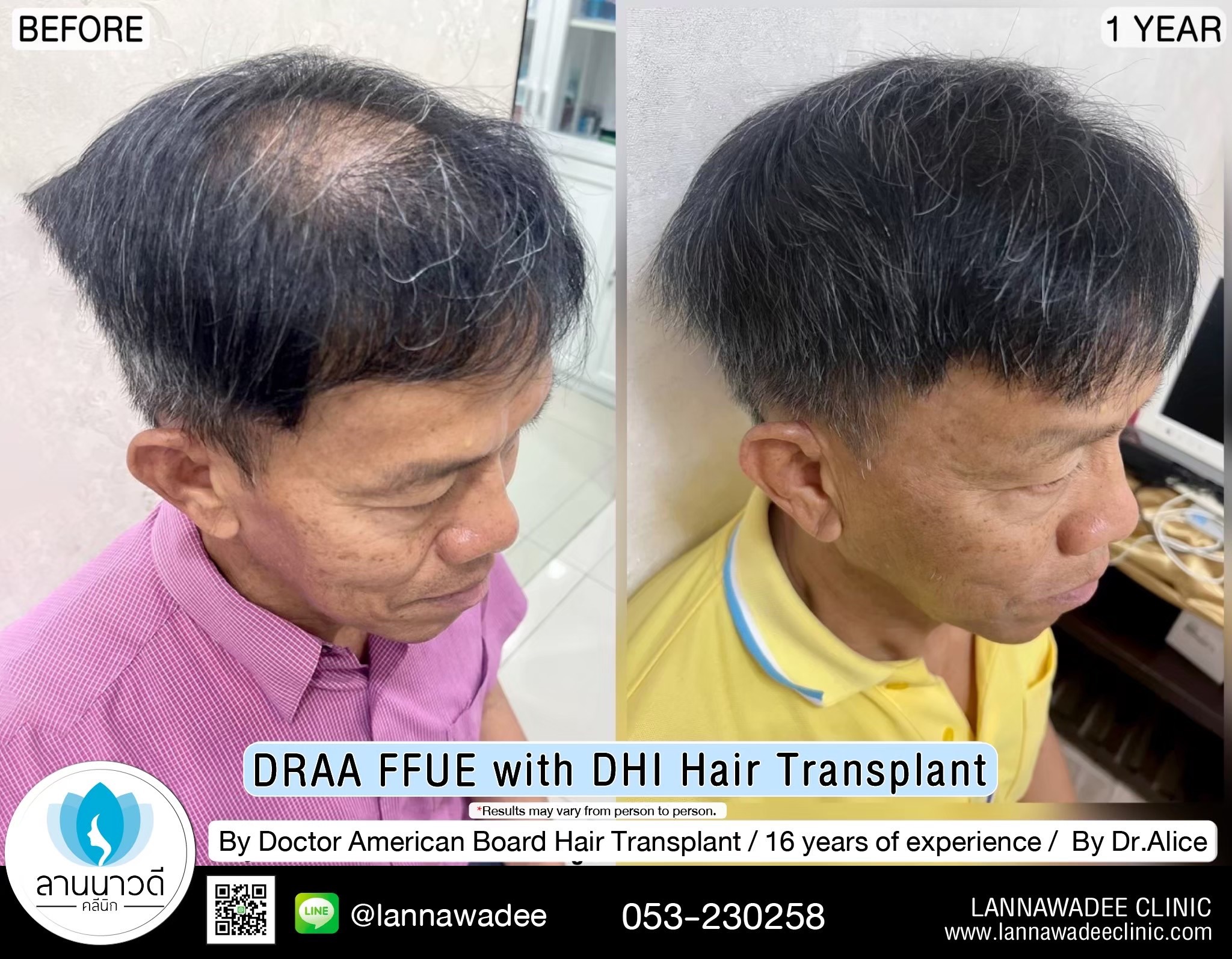 ABHRS hair transplant Thailand