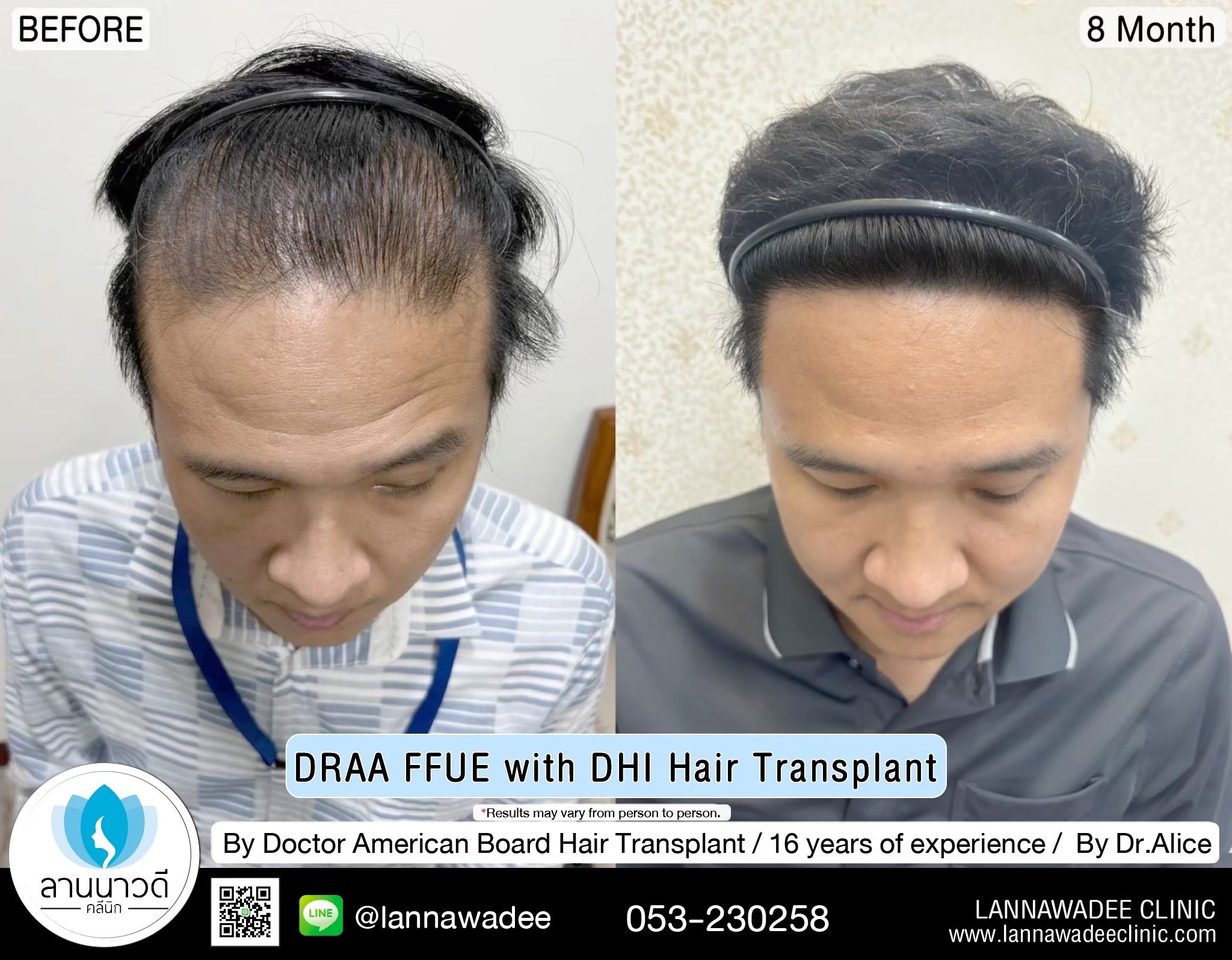 ABHRS hair transplant Thailand