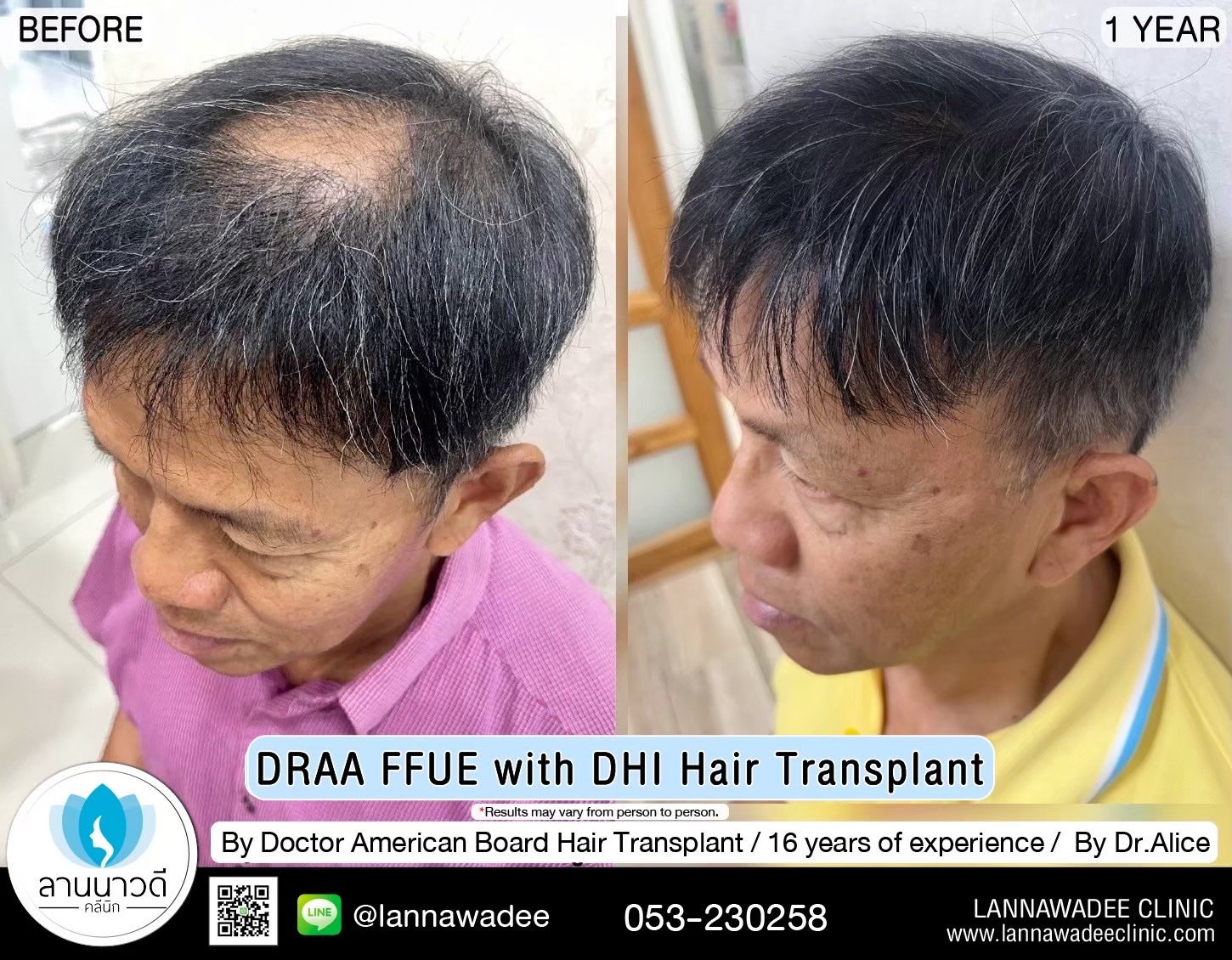 ABHRS hair transplant Thailand