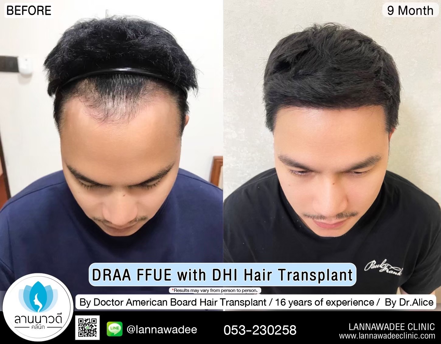 ABHRS hair transplant Thailand