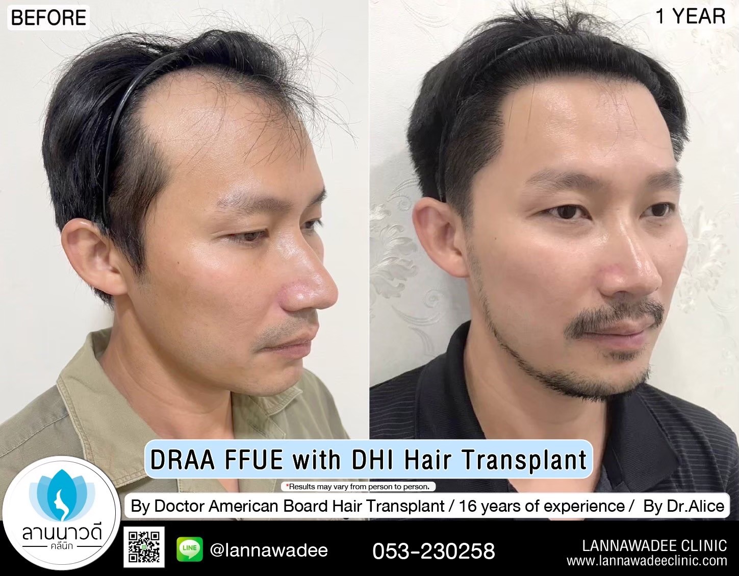 ABHRS hair transplant Thailand
