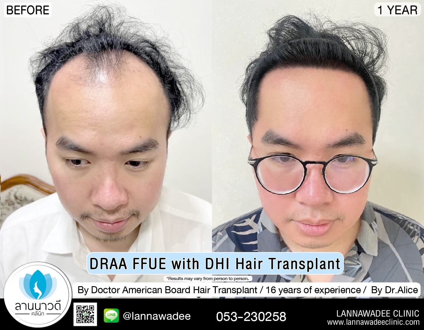 ABHRS hair transplant Thailand