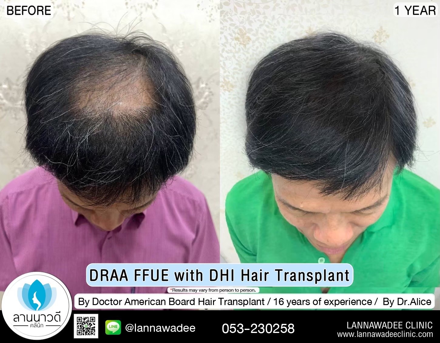 ABHRS hair transplant Thailand