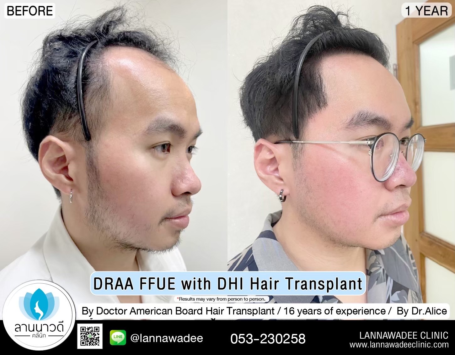 ABHRS hair transplant Thailand