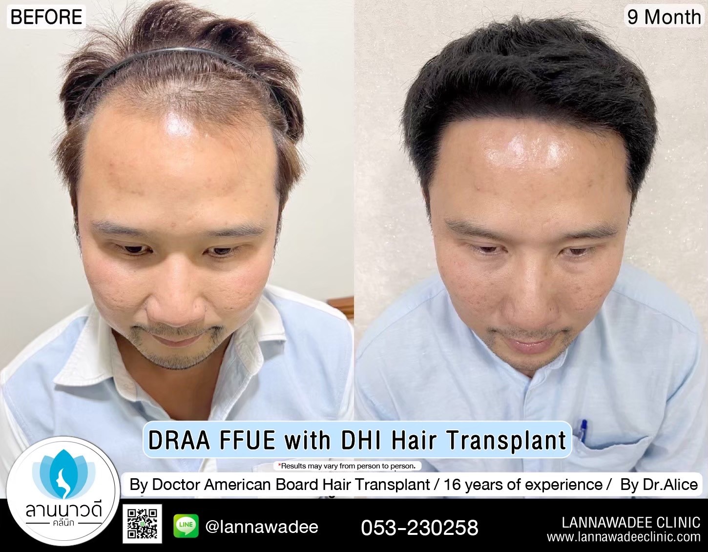 ABHRS hair transplant Thailand