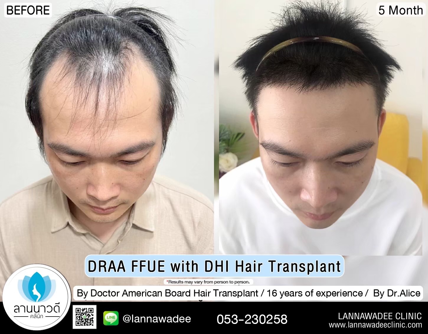 ABHRS hair transplant Thailand