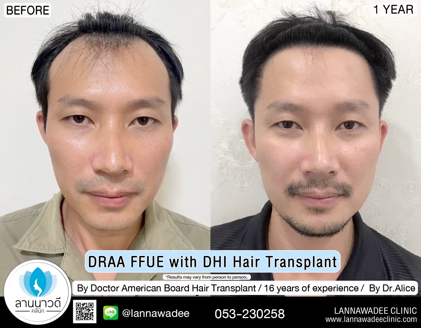 ABHRS hair transplant Thailand