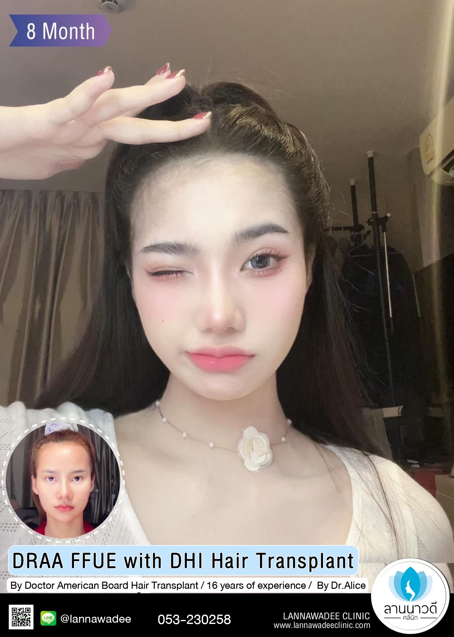 ABHRS hair transplant Thailand