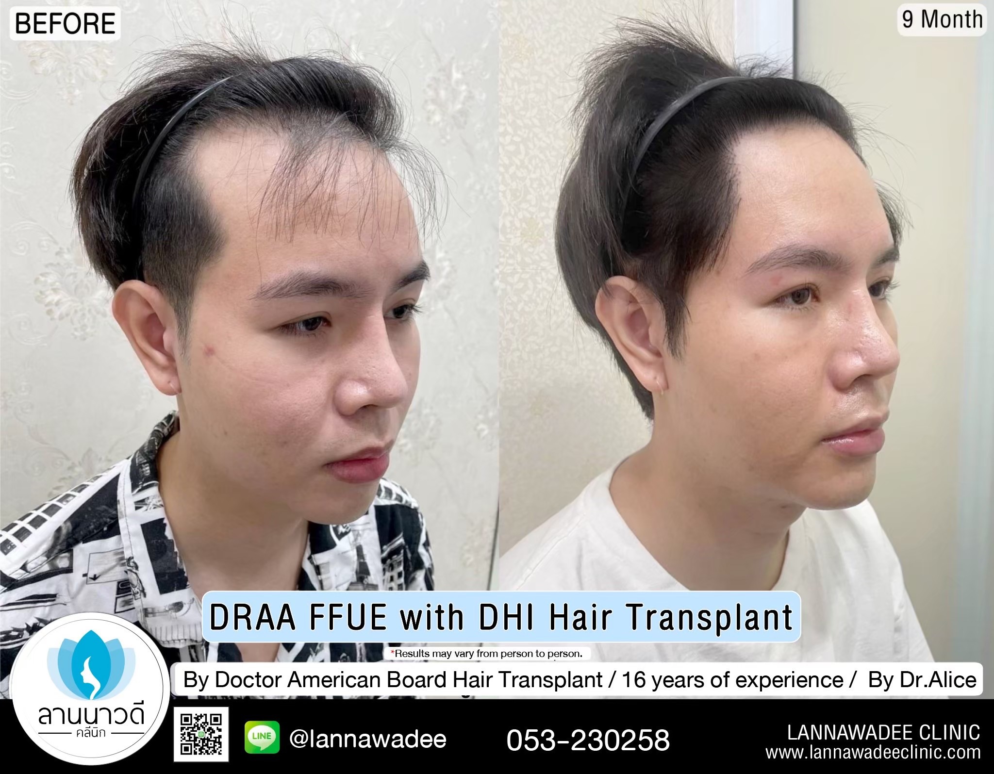 ABHRS hair transplant Thailand