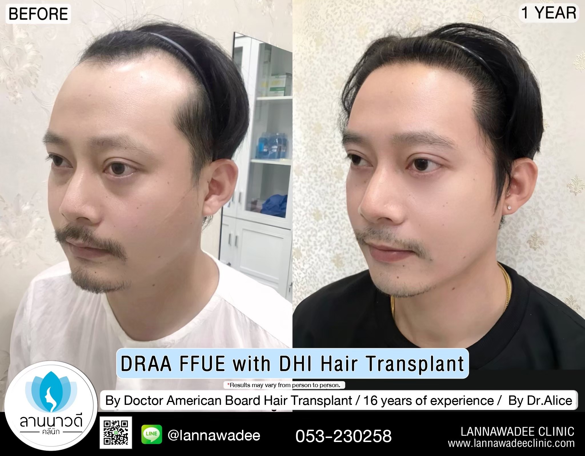 ABHRS hair transplant Thailand