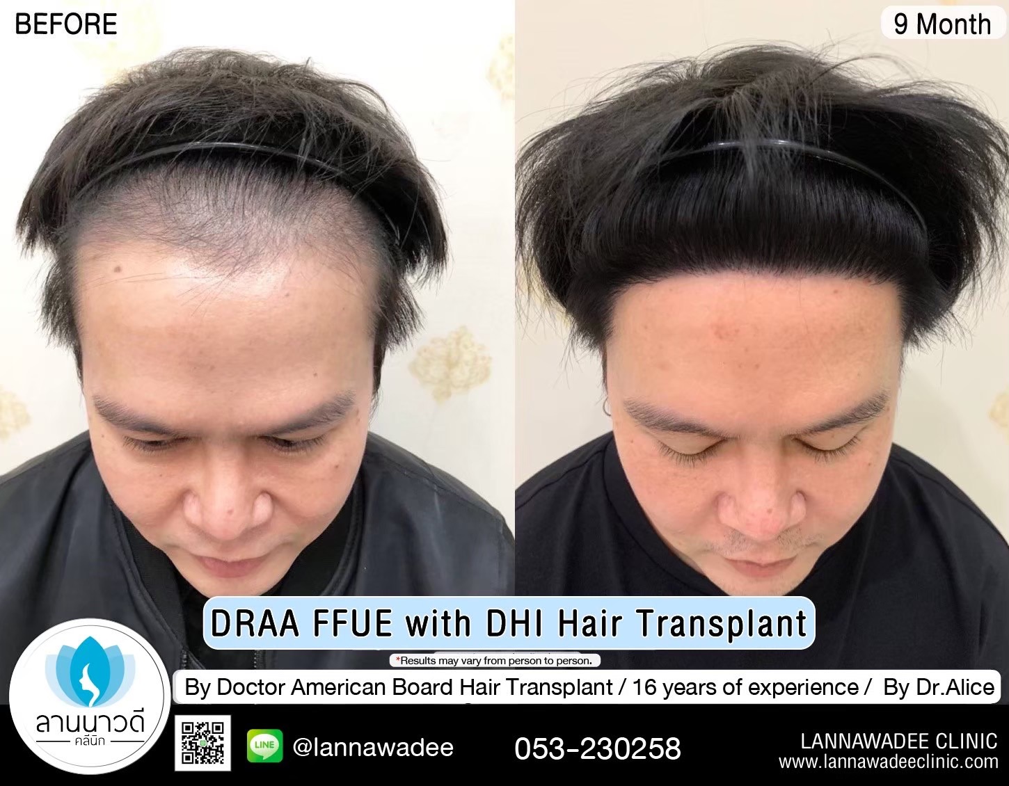 ABHRS hair transplant Thailand