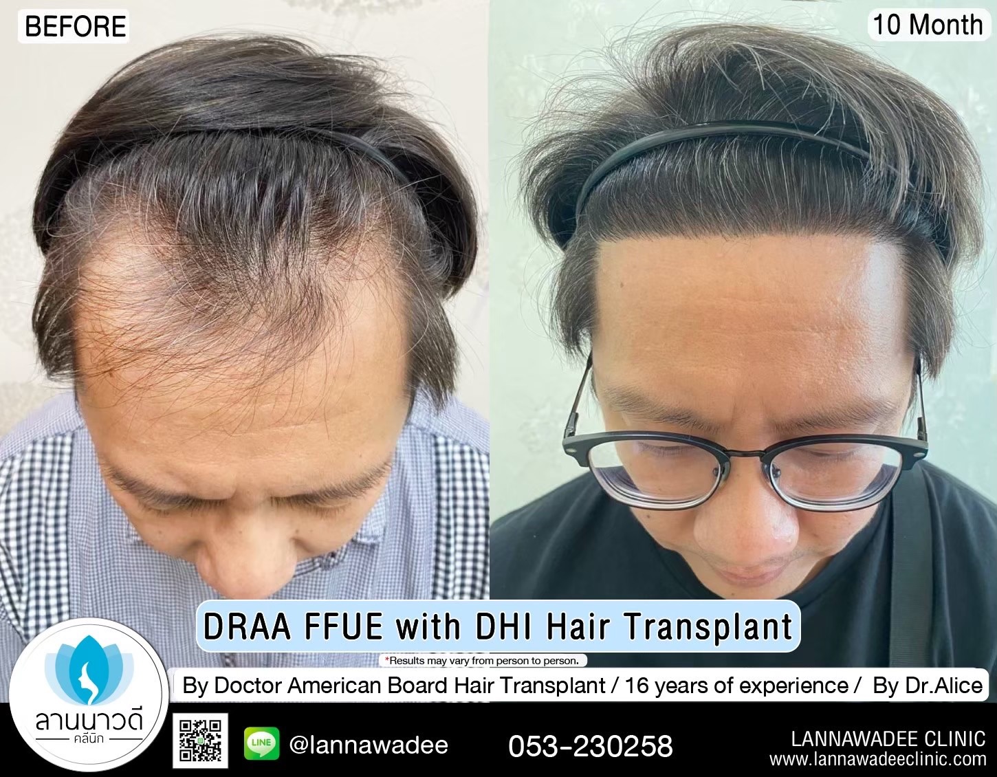 ABHRS hair transplant Thailand