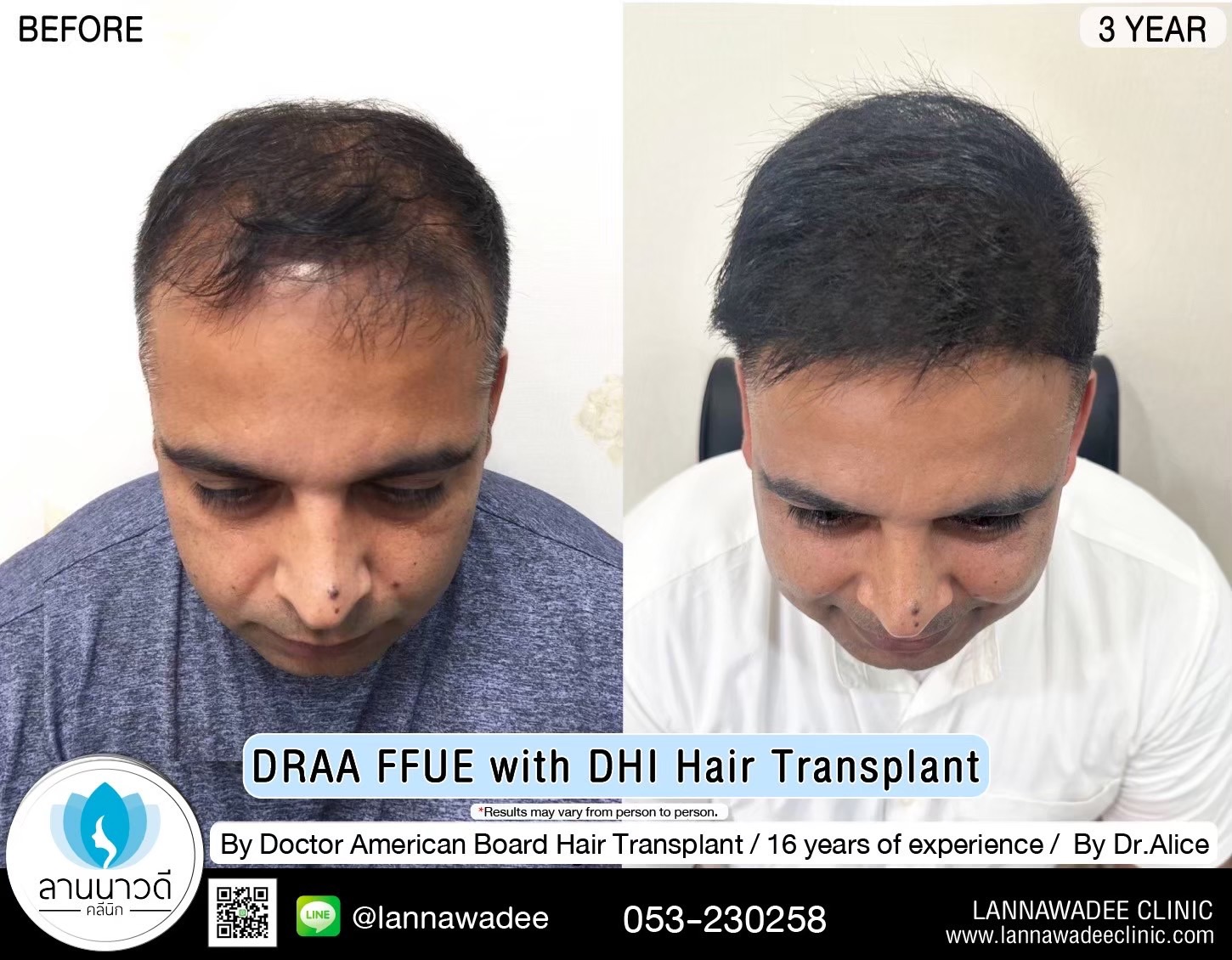 ABHRS hair transplant Thailand
