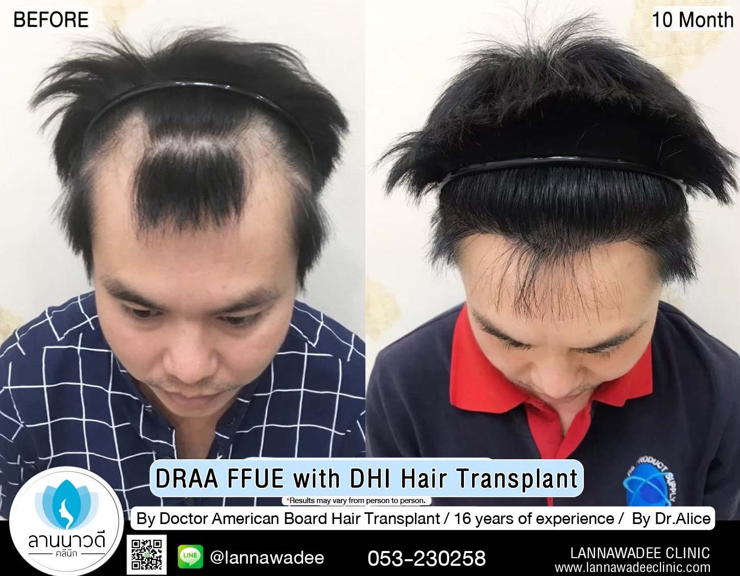 ABHRS hair transplant Thailand