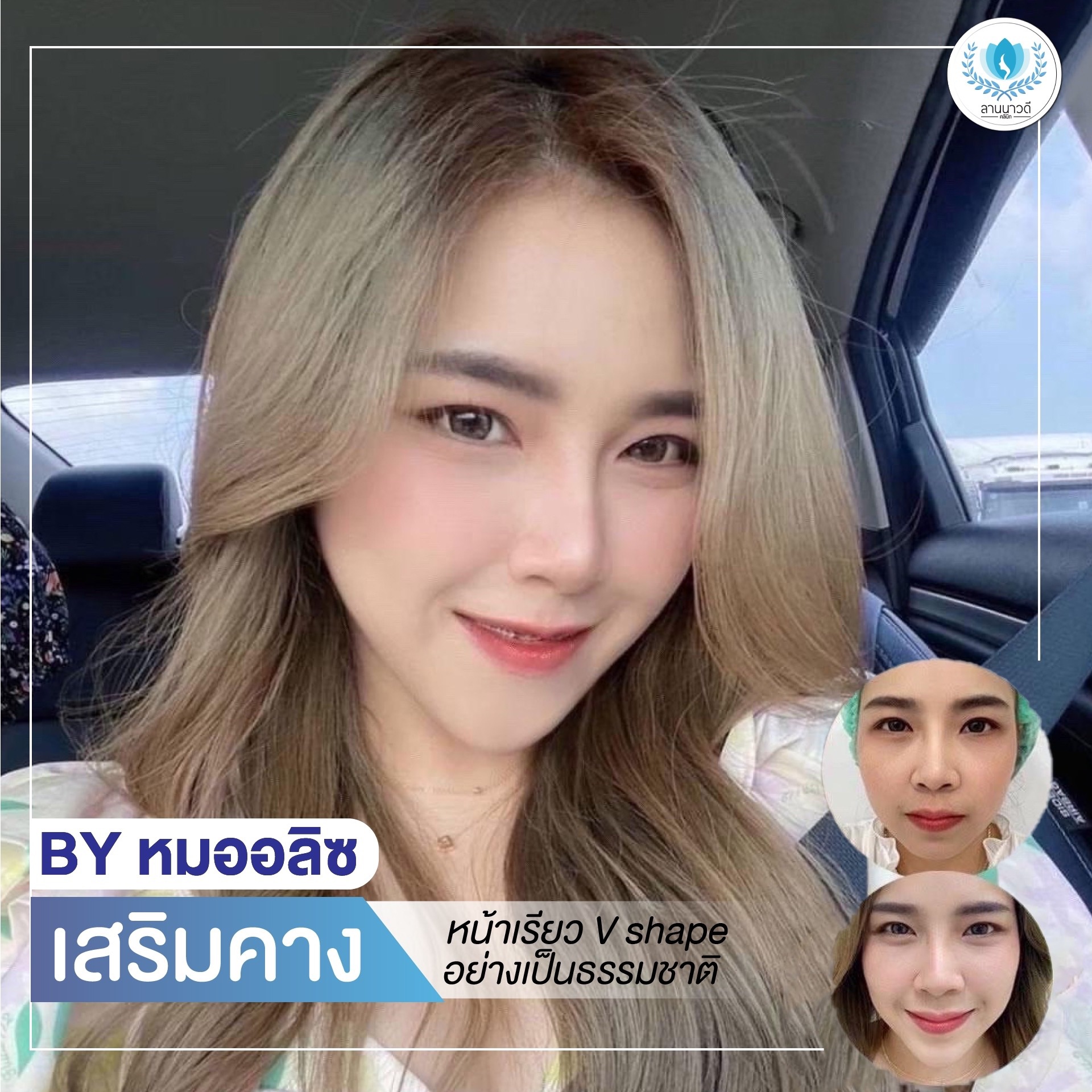 เสริมคาง