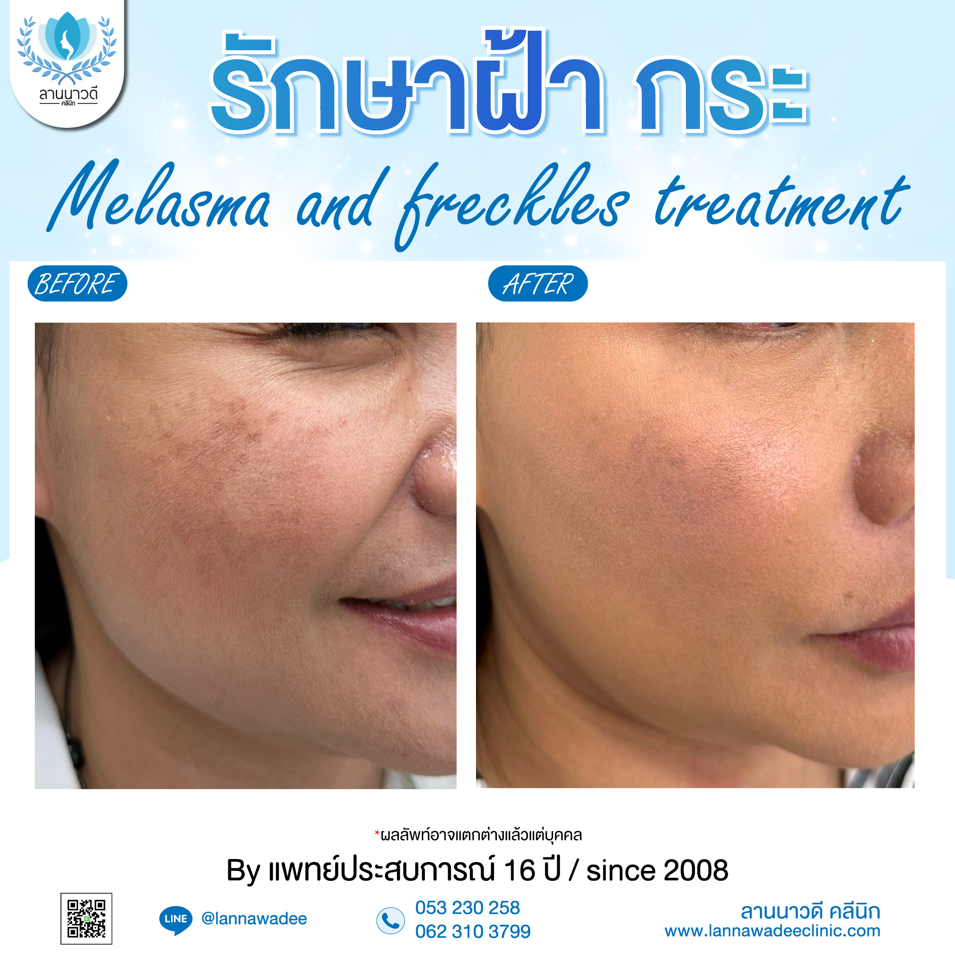 เลเซอร์ฝ้ากระที่ไหนดี