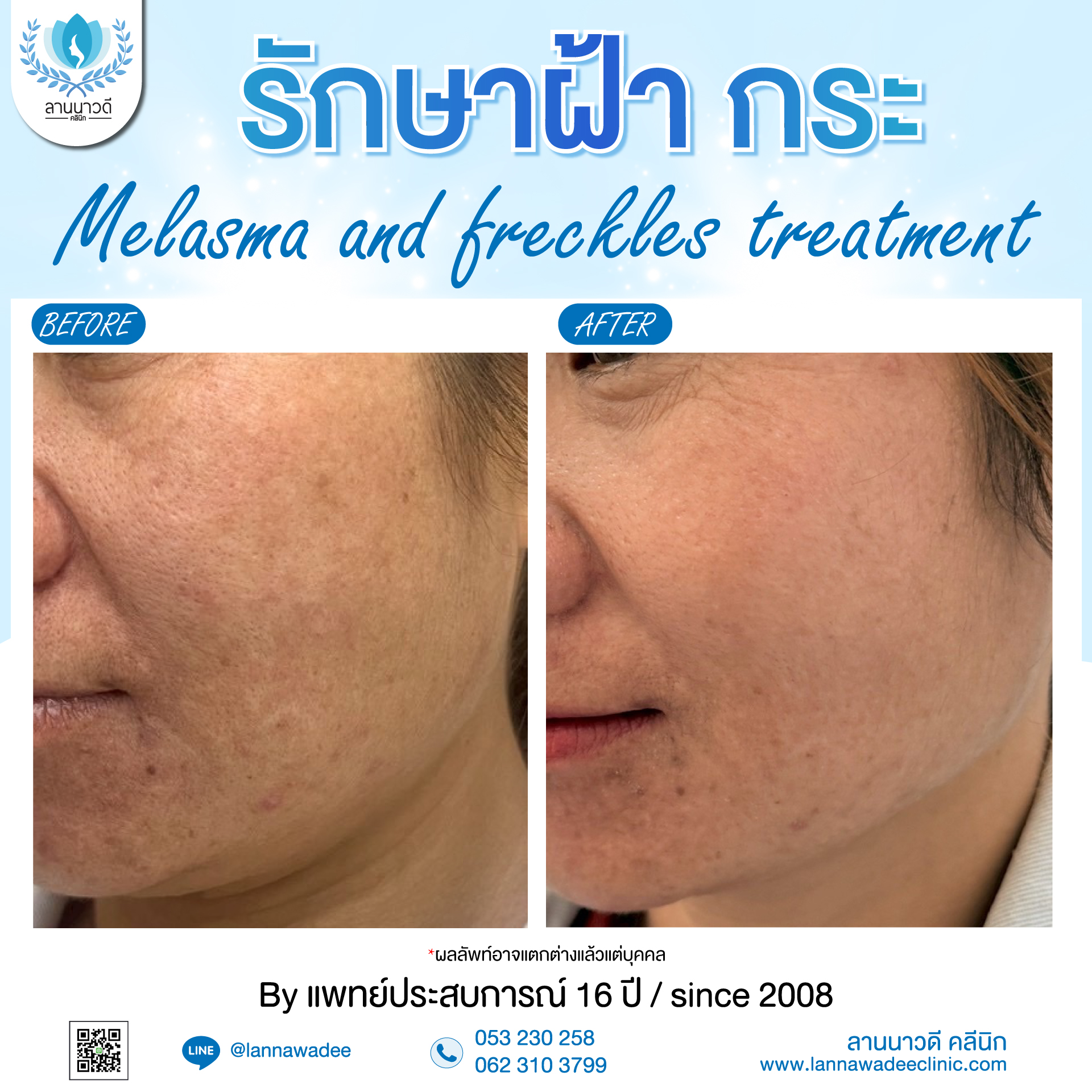 เลเซอร์