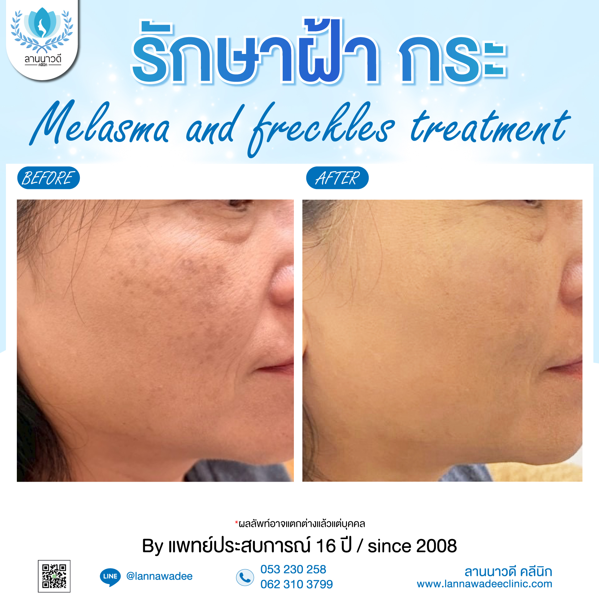 เลเซอร์ฝ้ากระที่ไหนดี