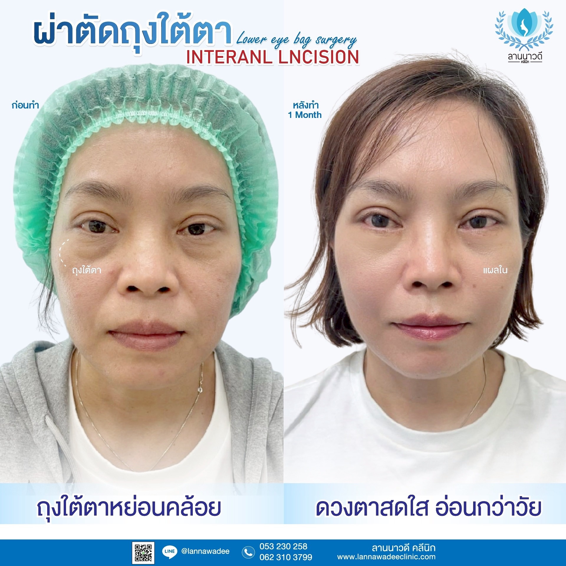 The best liposuction clinic