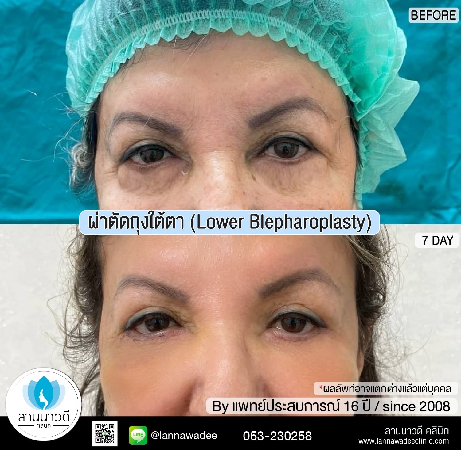 The best liposuction clinic