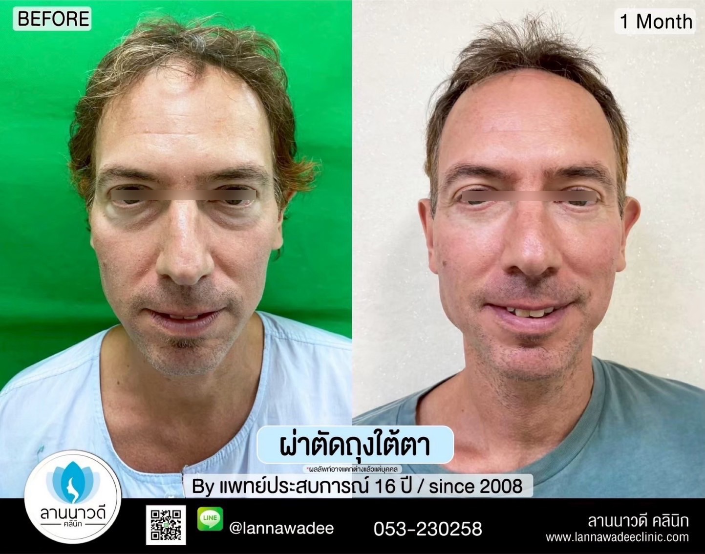 ผ่าตัดถุงใต้ตาเชียงใหม